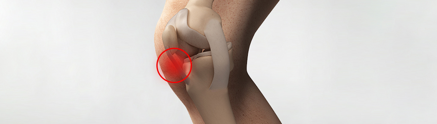 무릎 이미지